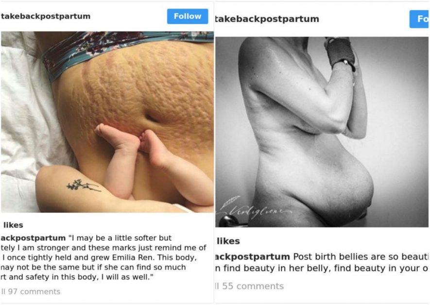Честные фото послеродового тела: женщины показали то, о чем не говорят