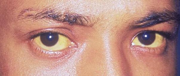 8 признаков, посредством которых Ваши глаза пытаются предупредить Вас о проблемах со здоровьем