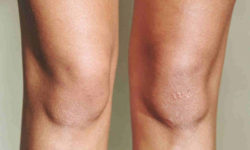 Что делать с дряблой кожей на коленях